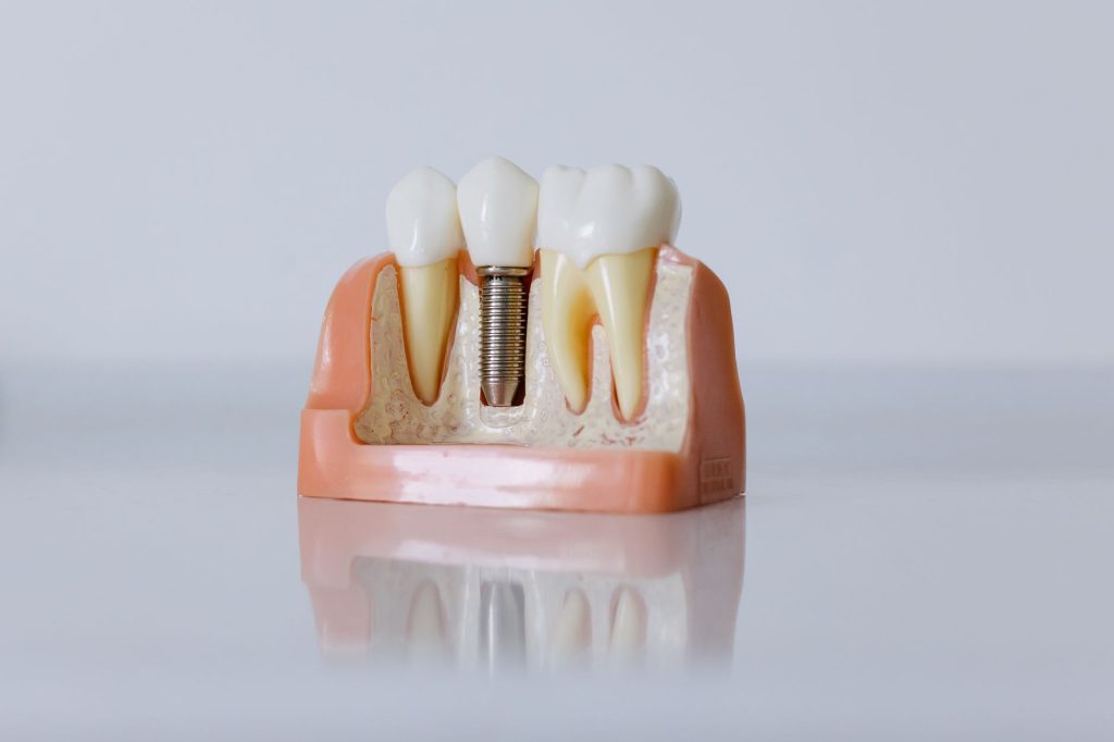 Dental Implants in Turkey: Cost, Process, and How to Choose the Right Clinic